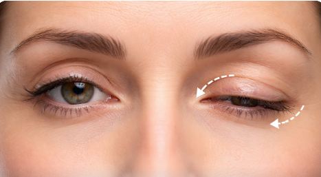 Что такое блефароптоз и как его устранить: Советы офтальмохирурга