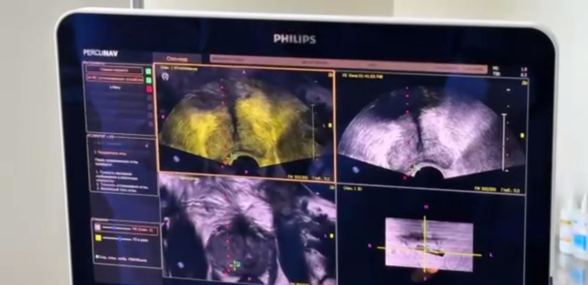 В Национальном онкоцентре внедрили фьюжн-биопсию