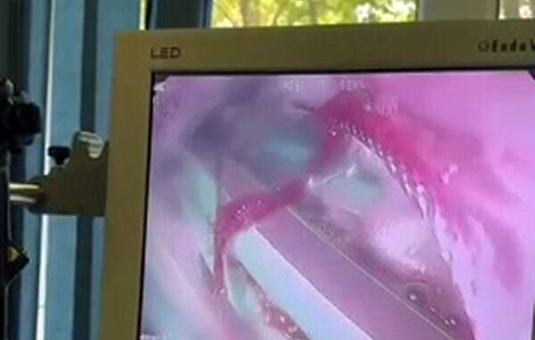 В Шымкенте мужчина проглотил 26 ручек на спор