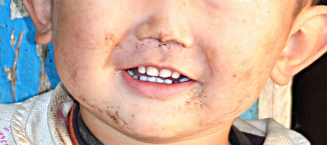 Можно ли поставить ребёнку брекеты в рамках ОСМС