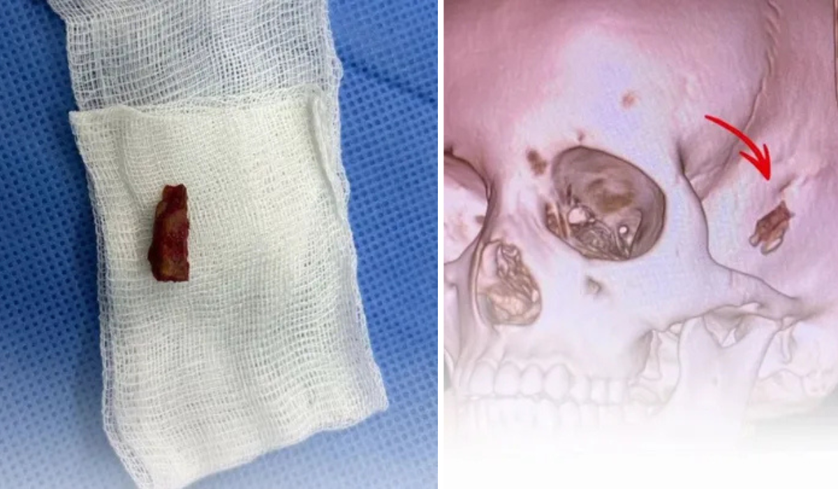 Врачи Павлодара удалили ветку из головы ребенка спустя 5 лет