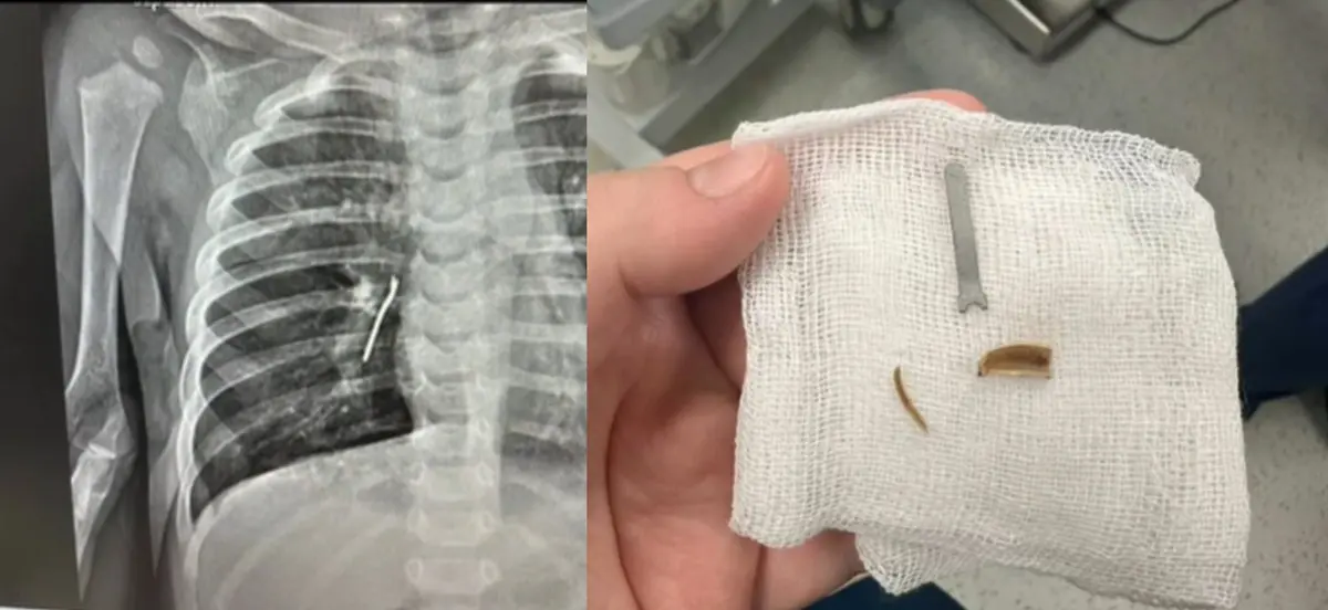 В Актау у годовалого ребёнка обнаружили металлический предмет в легких