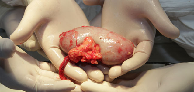 Донор из СКО спас жизни троих пациентов 