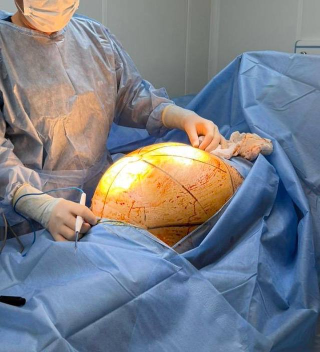 В Алматы пациентке удалили 25-килограммовую опухоль