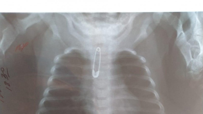 В Шымкенте врачи спасли малышку, в горле которой застряла булавка