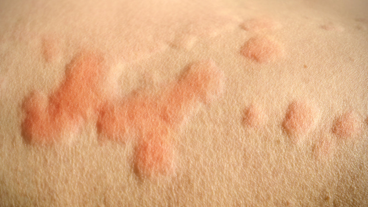 Как выглядит стрессовая сыпь, и как ее лечить