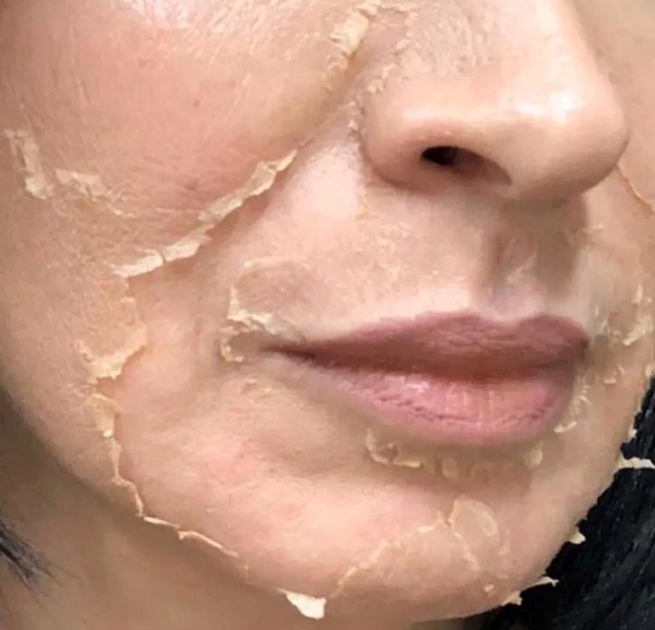 Морщины и прыщи ушли. Правда, вместе с кожей